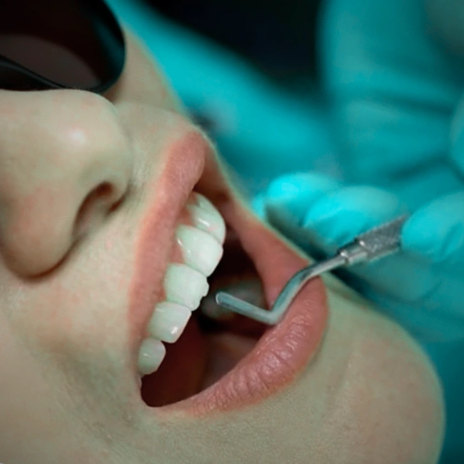 Composite Bonding in Applecross