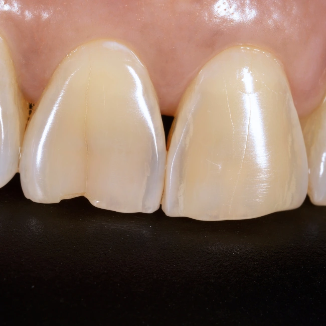 What Can Bonding Do?