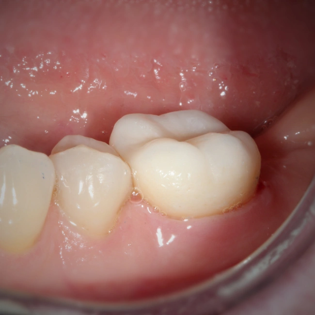 Crowns and Bridges in Applecross