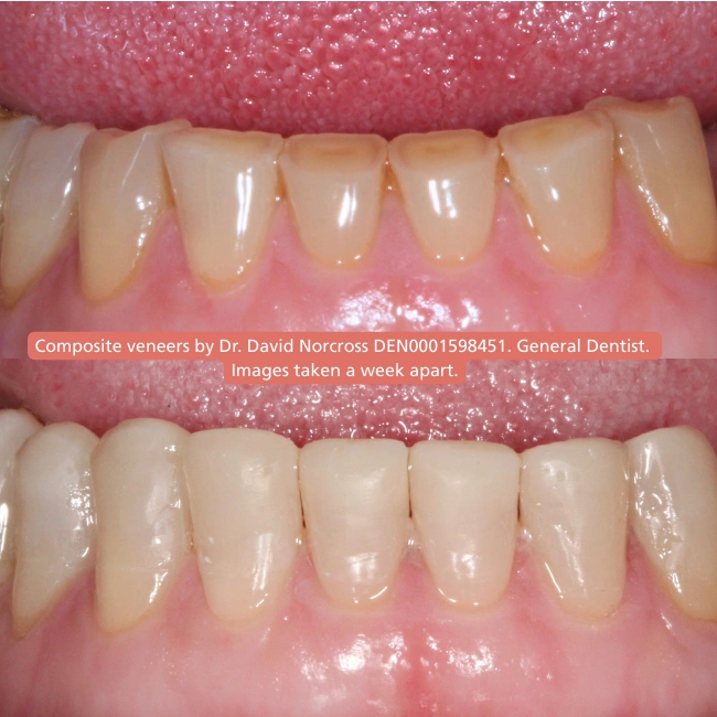 Why Choose Composite Veneers?