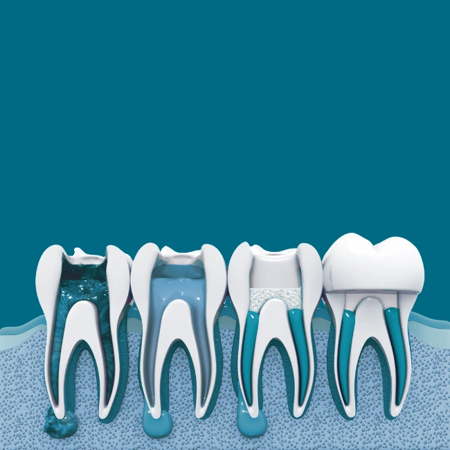 What is Root Canal Therapy?