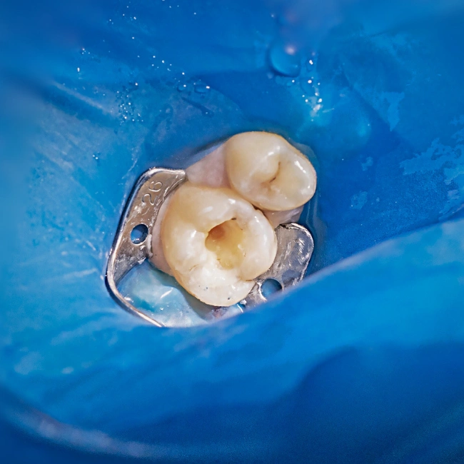 Composite Resin Fillings