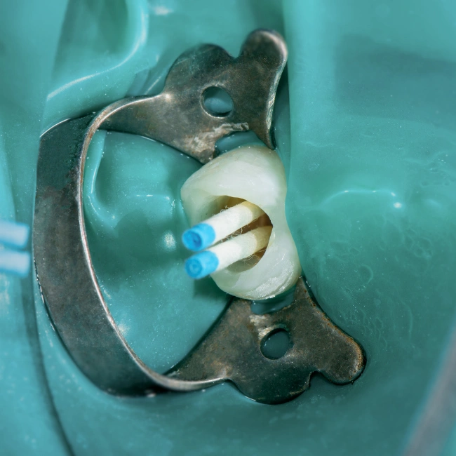 Who Might Need Root Canal Therapy?