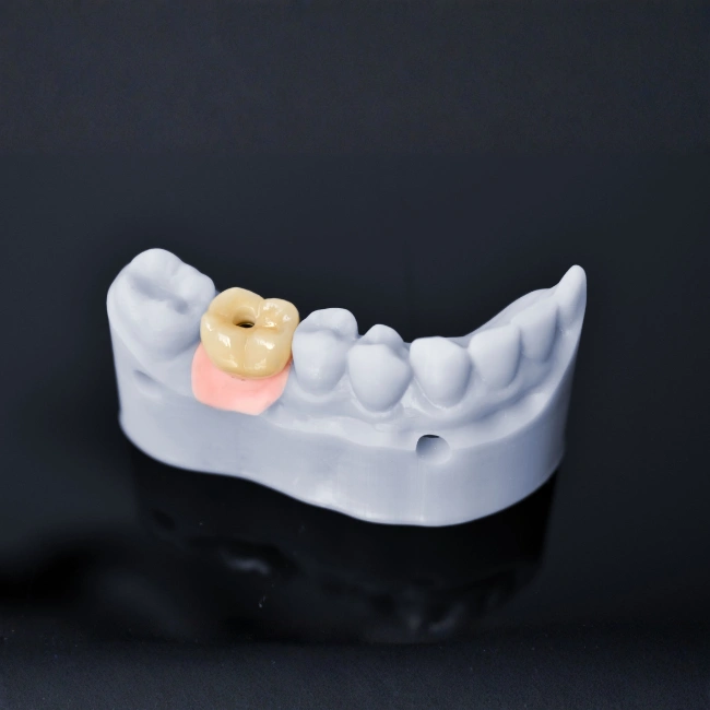 The Root Canal Treatment Process