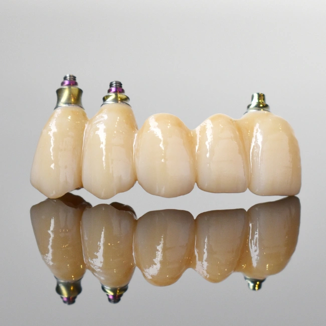 Alternate Crown and Bridge Solutions