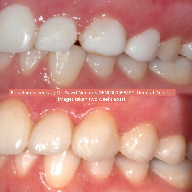 Why Choose Porcelain Veneers