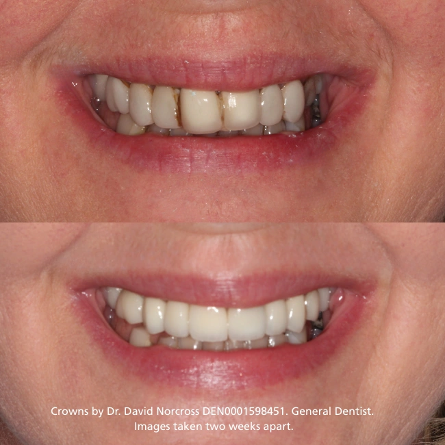 Smile Makeovers in Applecross