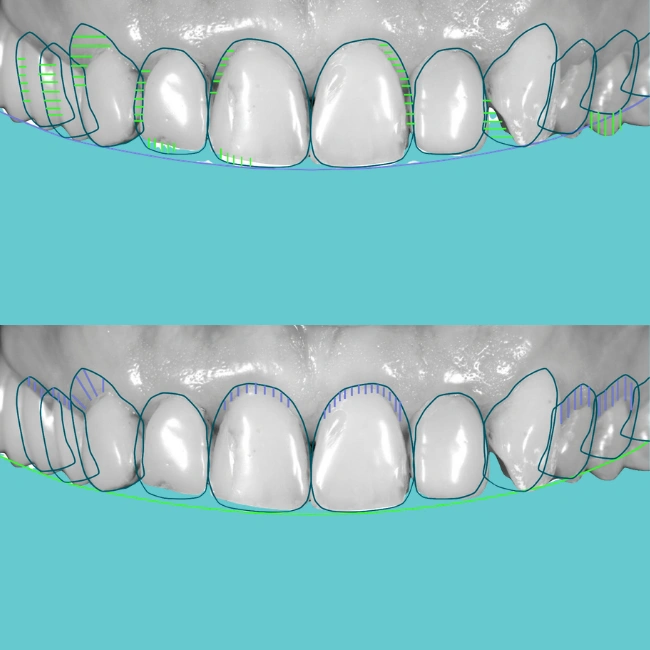 Smile Makeovers Using Digital Design Software