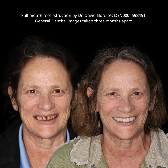 What Does a Smile Makeover Involve