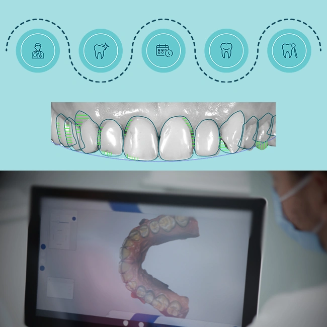 Porcelain Veneers Process