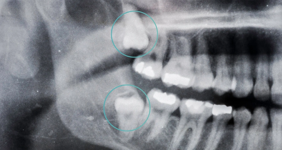 Wisdom Tooth Removal