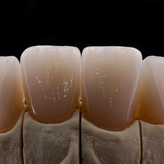 Veneers in Applecross