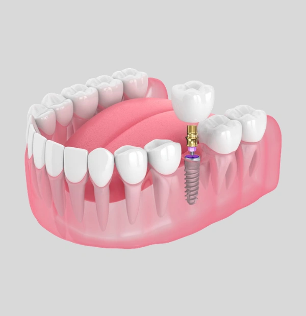 What Dental Implants Do