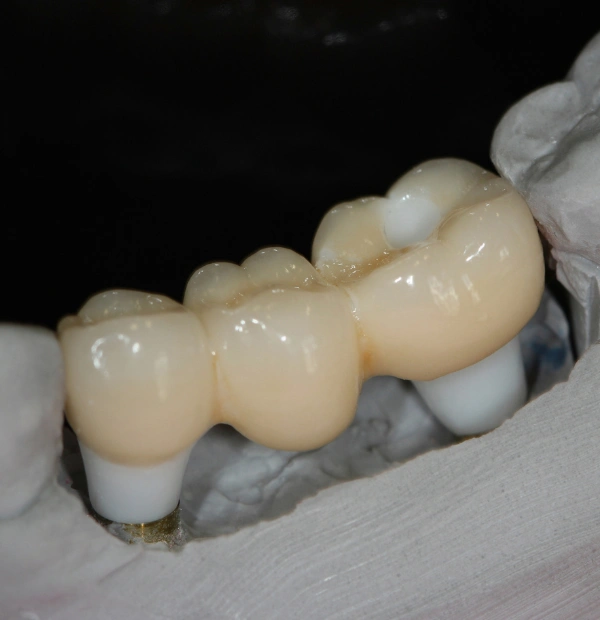 Fixed Implant Bridges